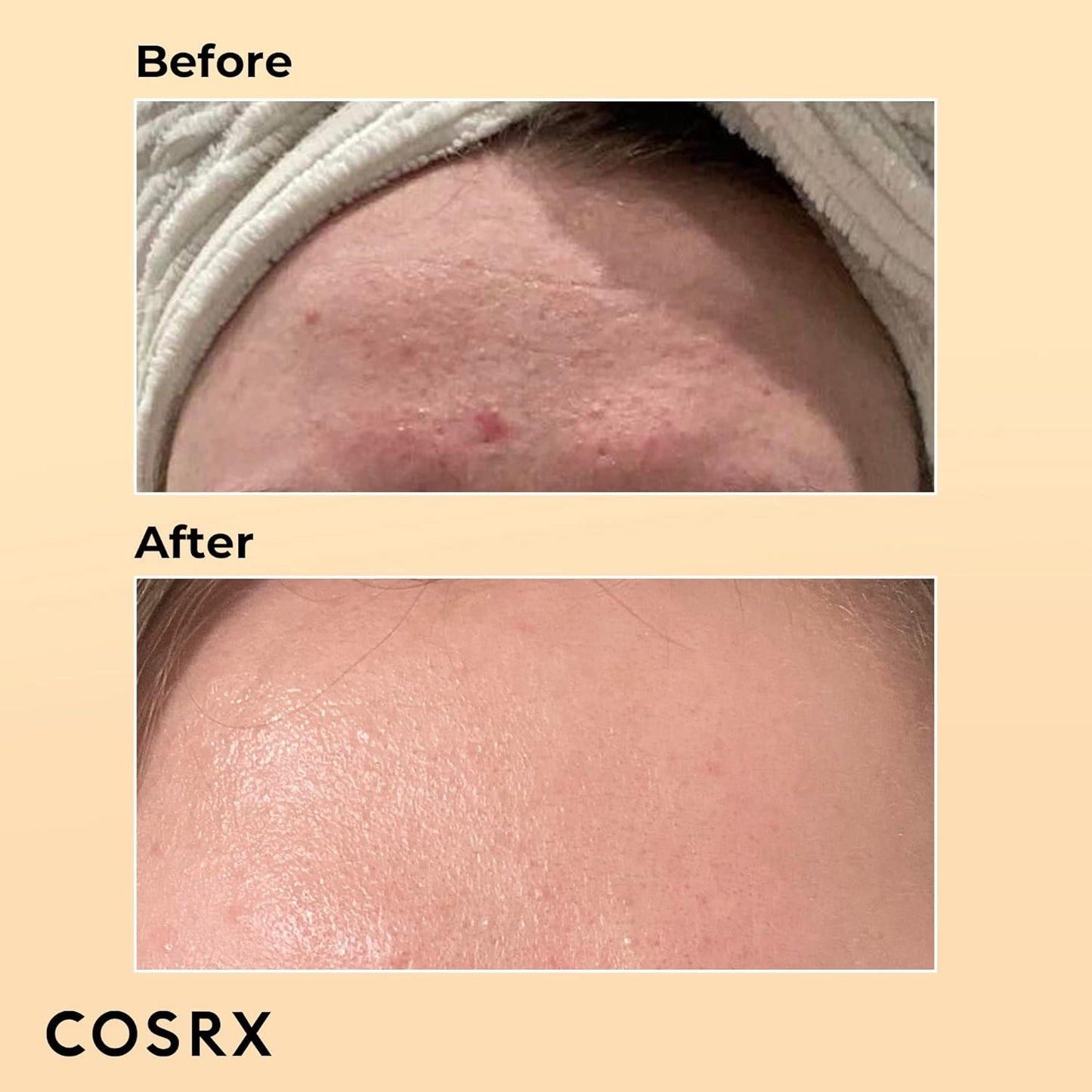 Before and after using COSRX Advanced Snail 96 Mucin Essence – visibly smoother, clearer and healthier looking skin